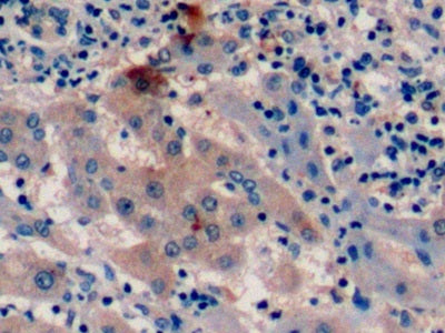 DAB staining on IHC-P; Sample: Human Liver cancer Tissue; Primary Ab: 10ug/ml Mouse Anti-Human aFP Antibody; Control: Used PBS instead of primary antibody; Second Ab: 2ug/ml HRP-Linked Caprine Anti-Mouse IgG Polyclonal Antibody