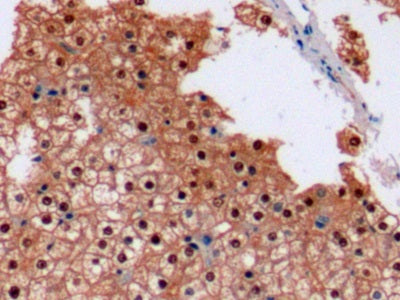 DAB staining on IHC-P; Sample: Human Liver cancer Tissue; Primary Ab: 10ug/ml Mouse Anti-Human Arg Antibody; Second Ab: 2ug/mL HRP-Linked Caprine Anti-Mouse IgG Polyclonal Antibody
