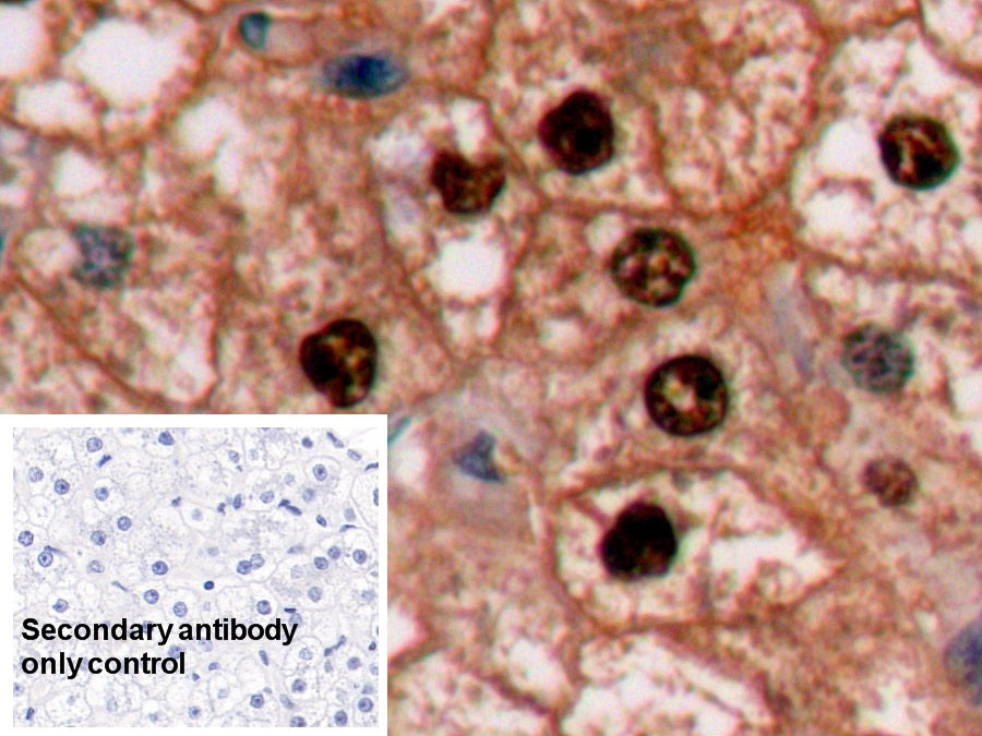 DAB staining on IHC-P; Sample: Human Liver cancer Tissue; Primary Ab: 10ug/ml Mouse Anti-Human Arg Antibody; Control: Used PBS instead of primary antibody; Second Ab: 2ug/ml HRP-Linked Caprine Anti-Mouse IgG Polyclonal Antibody
