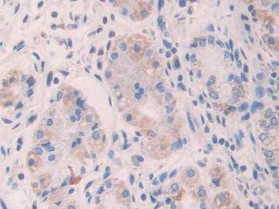 DAB staining on IHC-P; Sample: Human Colorectal cancer Tissue; Primary Ab: 40ug/ml Mouse Anti-Rat AGR2 Antibody; Second Ab: 2ug/mL HRP-Linked Caprine Anti-Mouse IgG Polyclonal Antibody