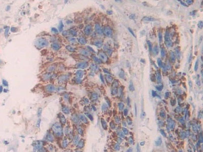 DAB staining on IHC-P; Sample: Human Stomach cancer Tissue; Primary Ab: 40ug/ml Mouse Anti-Rat AGR2 Antibody; Second Ab: 2ug/mL HRP-Linked Caprine Anti-Mouse IgG Polyclonal Antibody
