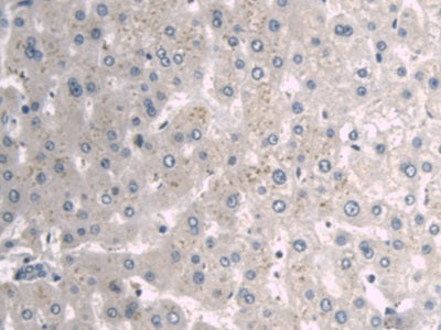 DAB staining on IHC-P; Sample: Human Prostate cancer Tissue; Primary Ab: 30ug/ml Mouse Anti-Human a1BG Antibody; Second Ab: 2ug/mL HRP-Linked Caprine Anti-Mouse IgG Polyclonal Antibody
