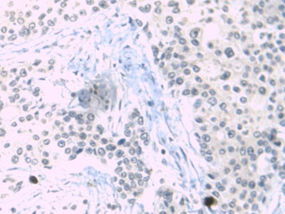 DAB staining on IHC-P; Sample: Human Liver Tissue; Primary Ab: 30ug/ml Mouse Anti-Human a1BG Antibody; Second Ab: 2ug/mL HRP-Linked Caprine Anti-Mouse IgG Polyclonal Antibody