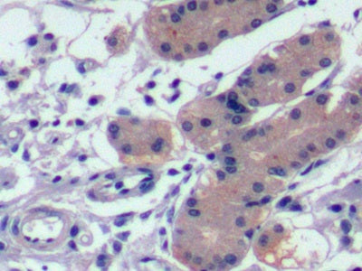 DAB staining on IHC-P; Sample: Human Liver Tissue; Primary Ab: 10ug/ml Mouse Anti-Human aFP Antibody; Second Ab: 2ug/mL HRP-Linked Caprine Anti-Mouse IgG Polyclonal Antibody