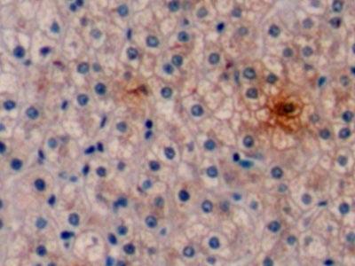 DAB staining on IHC-P; Sample: Human Liver cancer Tissue; Primary Ab: 10ug/ml Mouse Anti-Human aFP Antibody; Second Ab: 2ug/mL HRP-Linked Caprine Anti-Mouse IgG Polyclonal Antibody
