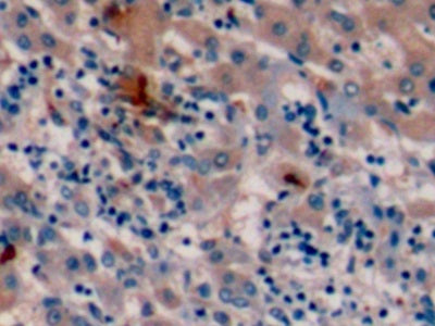 DAB staining on IHC-P; Sample: Human Liver Tissue; Primary Ab: 10ug/ml Mouse Anti-Human aFP Antibody; Control: Used PBS instead of primary antibody; Second Ab: 2ug/ml HRP-Linked Caprine Anti-Mouse IgG Polyclonal Antibody