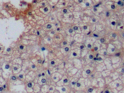 DAB staining on IHC-P; Sample: Human Liver cancer Tissue; Primary Ab: 10ug/ml Mouse Anti-Human aFP Antibody; Second Ab: 2ug/mL HRP-Linked Caprine Anti-Mouse IgG Polyclonal Antibody