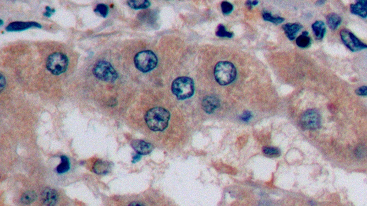 DAB staining on IHC-P; Sample: Human Liver Tissue; Primary Ab: 10ug/ml Mouse Anti-Human aFP Antibody; Control: Used PBS instead of primary antibody; Second Ab: 2ug/ml HRP-Linked Caprine Anti-Mouse IgG Polyclonal Antibody