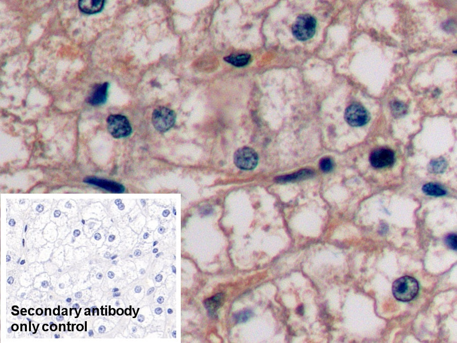 DAB staining on IHC-P; Sample: Human Liver cancer Tissue; Primary Ab: 10ug/ml Mouse Anti-Human aFP Antibody; Control: Used PBS instead of primary antibody; Second Ab: 2ug/ml HRP-Linked Caprine Anti-Mouse IgG Polyclonal Antibody