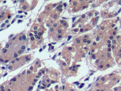 DAB staining on IHC-P; Sample: Human Liver cancer Tissue; Primary Ab: 10ug/ml Mouse Anti-Human aFP Antibody; Second Ab: 2ug/mL HRP-Linked Caprine Anti-Mouse IgG Polyclonal Antibody