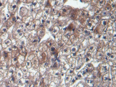 DAB staining on IHC-P; Sample: Human Liver cancer Tissue; Primary Ab: 10ug/ml Mouse Anti-Human aFP Antibody; Second Ab: 2ug/mL HRP-Linked Caprine Anti-Mouse IgG Polyclonal Antibody