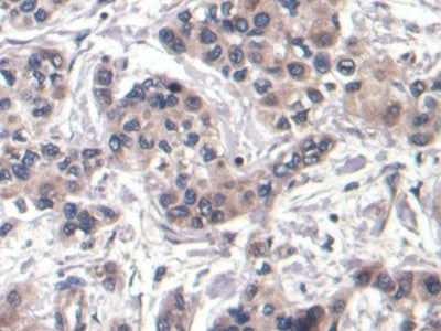 DAB staining on IHC-P; Sample: Human Liver Tissue; Primary Ab: 10ug/ml Mouse Anti-Human aFP Antibody; Control: Used PBS instead of primary antibody; Second Ab: 2ug/ml HRP-Linked Caprine Anti-Mouse IgG Polyclonal Antibody