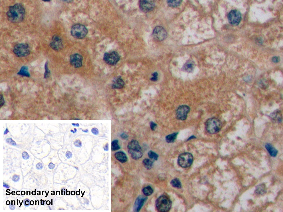 DAB staining on IHC-P; Sample: Human Liver cancer Tissue; Primary Ab: 10ug/ml Mouse Anti-Human aFP Antibody; Control: Used PBS instead of primary antibody; Second Ab: 2ug/ml HRP-Linked Caprine Anti-Mouse IgG Polyclonal Antibody