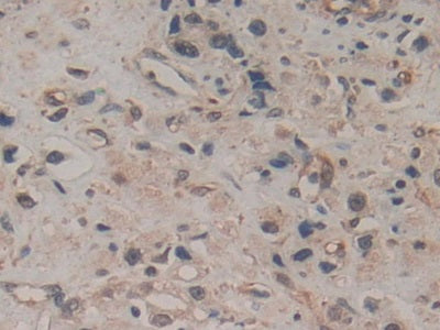 DAB staining on IHC-P; Sample: Human Pancreatic cancer Tissue; Primary Ab: 20ug/ml Mouse Anti-Human AREG Antibody; Second Ab: 2ug/mL HRP-Linked Caprine Anti-Mouse IgG Polyclonal Antibody