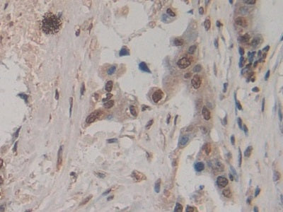 DAB staining on IHC-P; Sample: Human Breast cancer Tissue; Primary Ab: 20ug/ml Mouse Anti-Human AREG Antibody; Second Ab: 2ug/mL HRP-Linked Caprine Anti-Mouse IgG Polyclonal Antibody