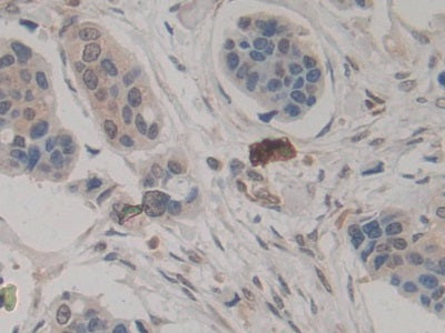 DAB staining on IHC-P; Sample: Human Colorectal cancer Tissue; Primary Ab: 20ug/ml Mouse Anti-Human AREG Antibody; Second Ab: 2ug/mL HRP-Linked Caprine Anti-Mouse IgG Polyclonal Antibody