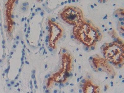 DAB staining on IHC-P; Sample: Human Prostate cancer Tissue; Primary Ab: 20ug/ml Mouse Anti-Human AREG Antibody; Second Ab: 2ug/mL HRP-Linked Caprine Anti-Mouse IgG Polyclonal Antibody