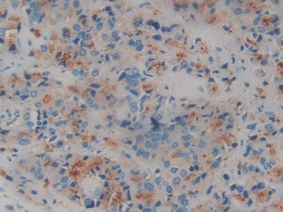 DAB staining on IHC-P; Sample: Human Glioma Tissue; Primary Ab: 30ug/ml Mouse Anti-Human AREG Antibody; Second Ab: 2ug/mL HRP-Linked Caprine Anti-Mouse IgG Polyclonal Antibody