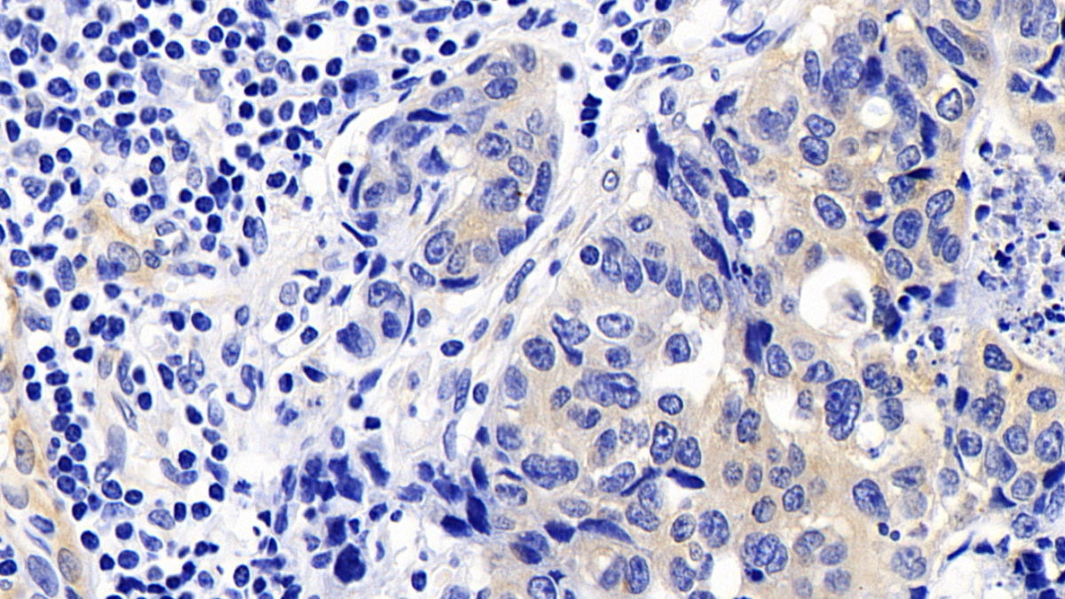 DAB staining on IHC-P; Sample: Human Lung cancer Tissue; Primary Ab: 20ug/ml Mouse Anti-Human CASP9 Antibody; Second Ab: 2ug/mL HRP-Linked Caprine Anti-Mouse IgG Polyclonal Antibody