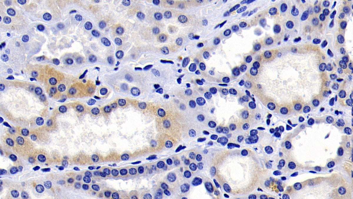 DAB staining on IHC-P; Sample: Human Lymphoma Tissue; Primary Ab: 20ug/ml Mouse Anti-Human CASP9 Antibody; Second Ab: 2ug/mL HRP-Linked Caprine Anti-Mouse IgG Polyclonal Antibody