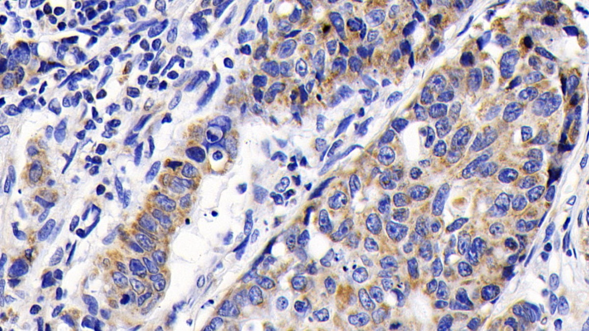 DAB staining on IHC-P; Sample: Human Lung cancer Tissue; Primary Ab: 20ug/ml Mouse Anti-Human CASP9 Antibody; Second Ab: 2ug/mL HRP-Linked Caprine Anti-Mouse IgG Polyclonal Antibody