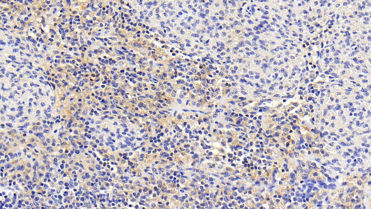 DAB staining on IHC-P; Sample: Human Lymph node Tissue; Primary Ab: 20ug/ml Mouse Anti-Human SQSTM1 Antibody; Second Ab: 2ug/mL HRP-Linked Caprine Anti-Mouse IgG Polyclonal Antibody