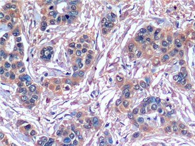 DAB staining on IHC-P; Sample: Human Liver cancer Tissue; Primary Ab: 10ug/ml Mouse Anti-Human SERPINB3 Antibody; Control: Used PBS instead of primary antibody; Second Ab: 2ug/ml HRP-Linked Caprine Anti-Mouse IgG Polyclonal Antibody