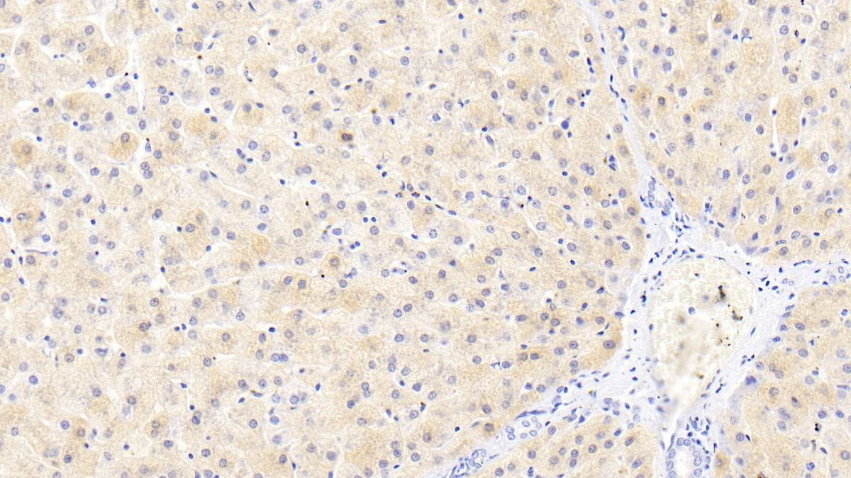 DAB staining on IHC-P; Sample: Human Liver Tissue; Primary Ab: 20ug/ml Mouse Anti-Human FTL Antibody; Control: Used PBS instead of primary antibody; Second Ab: 2ug/ml HRP-Linked Caprine Anti-Mouse IgG Polyclonal Antibody