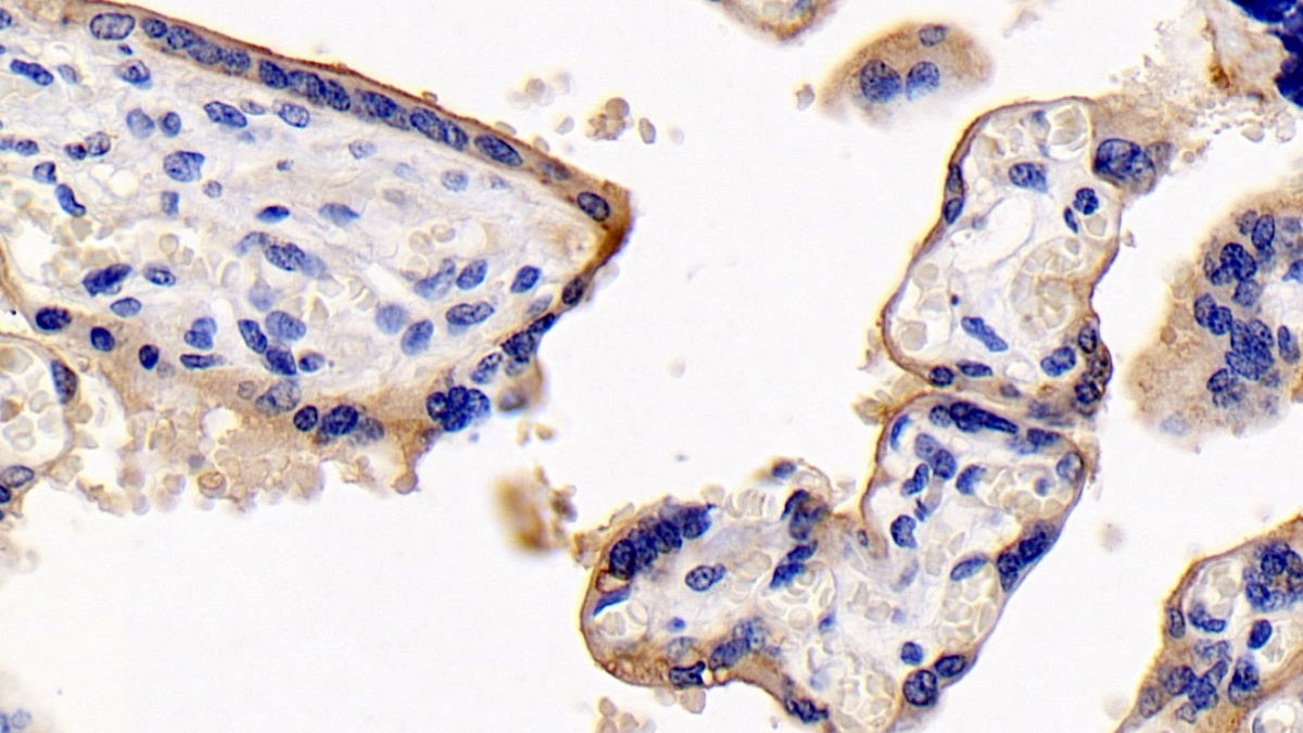 DAB staining on IHC-P; Sample: Human Lung cancer Tissue; Primary Ab: 30ug/ml Mouse Anti-Human CD147 Antibody; Second Ab: 2ug/mL HRP-Linked Caprine Anti-Mouse IgG Polyclonal Antibody