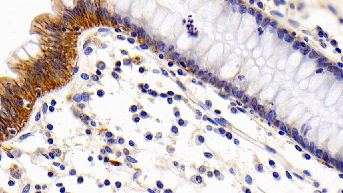 DAB staining on IHC-P; Sample: Human Ovarian cancer Tissue; Primary Ab: 30ug/ml Mouse Anti-Human CD147 Antibody; Second Ab: 2ug/mL HRP-Linked Caprine Anti-Mouse IgG Polyclonal Antibody