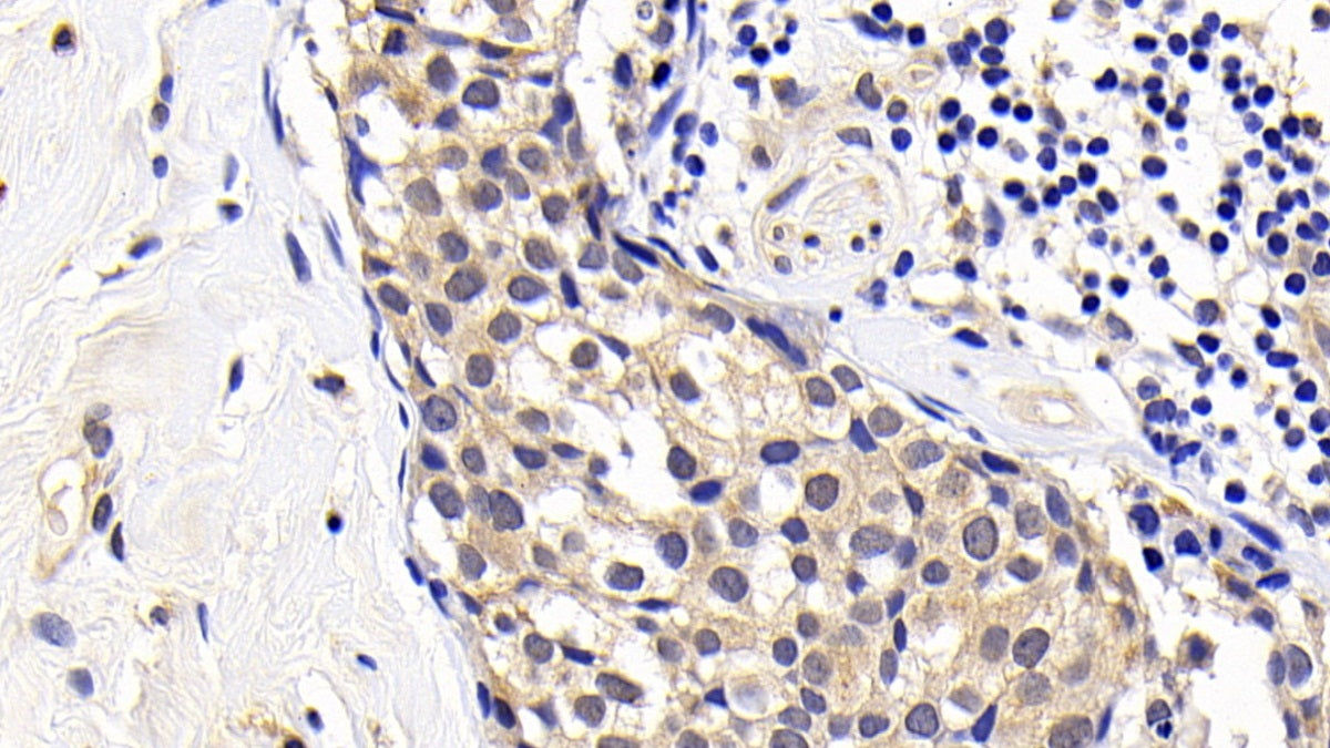 DAB staining on IHC-P; Sample: Human Endometrial cancer Tissue; Primary Ab: 30ug/ml Mouse Anti-Human Bcl2 Antibody; Second Ab: 2ug/mL HRP-Linked Caprine Anti-Mouse IgG Polyclonal Antibody