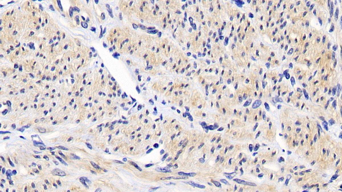 DAB staining on IHC-P; Sample: Human Thyroid cancer Tissue; Primary Ab: 30ug/ml Mouse Anti-Human Bcl2 Antibody; Second Ab: 2ug/mL HRP-Linked Caprine Anti-Mouse IgG Polyclonal Antibody