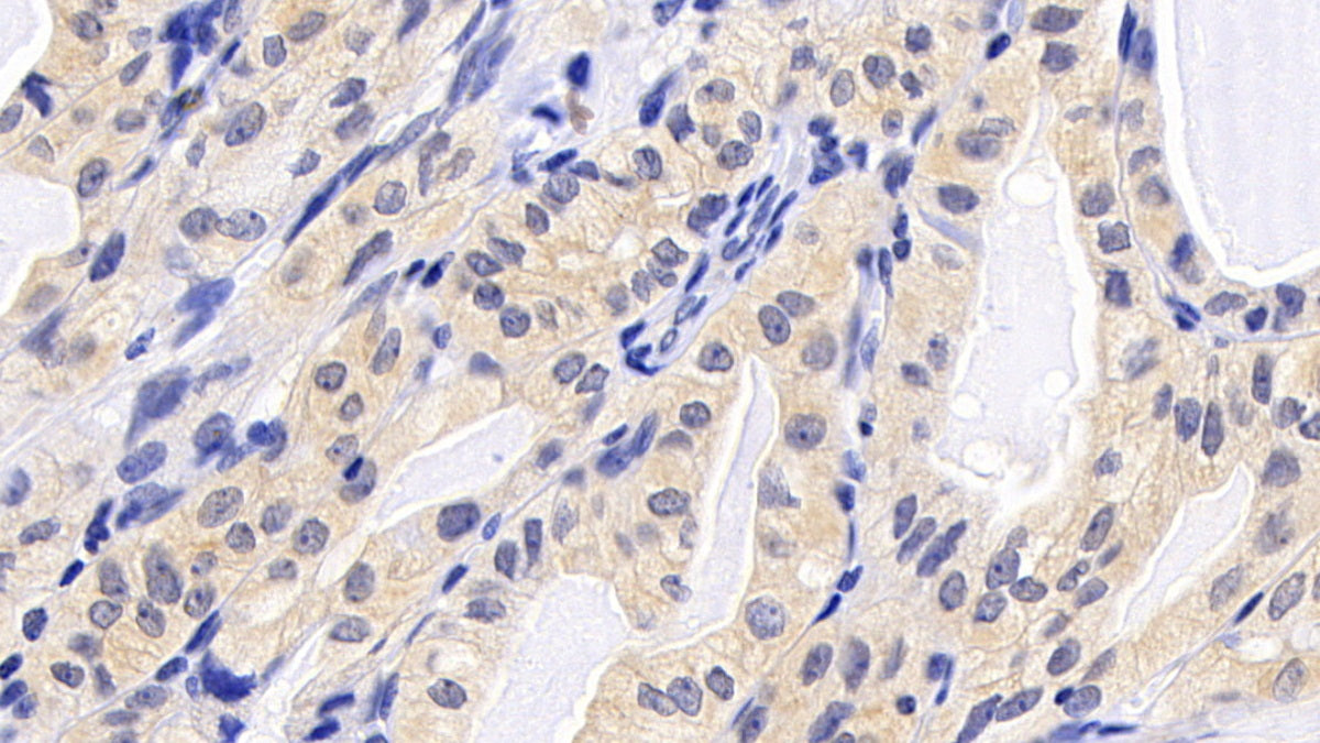 DAB staining on IHC-P; Sample: Human Appendix Tissue; Primary Ab: 30ug/ml Mouse Anti-Human Bcl2 Antibody; Second Ab: 2ug/mL HRP-Linked Caprine Anti-Mouse IgG Polyclonal Antibody