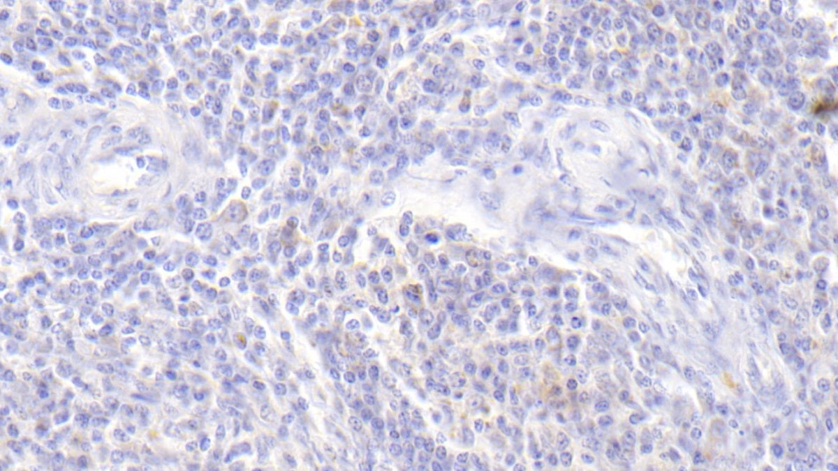 DAB staining on IHC-P; Sample: Human Liver Tissue; Primary Ab: 20ug/ml Mouse Anti-Human a1AT Antibody; Second Ab: 2ug/mL HRP-Linked Caprine Anti-Mouse IgG Polyclonal Antibody