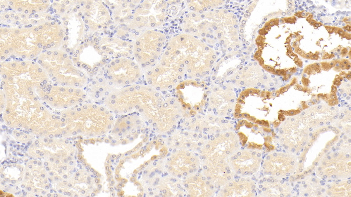 DAB staining on IHC-P; Sample: Human Liver Tissue; Primary Ab: 20ug/ml Mouse Anti-Human a1AT Antibody; Second Ab: 2ug/mL HRP-Linked Caprine Anti-Mouse IgG Polyclonal Antibody