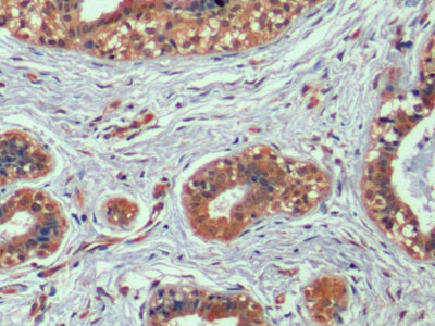 DAB staining on IHC-P; Sample: Human Lymphoma Tissue; Primary Ab: 10ug/ml Mouse Anti-Human HAVCR2 Antibody; Second Ab: 2ug/mL HRP-Linked Caprine Anti-Mouse IgG Polyclonal Antibody