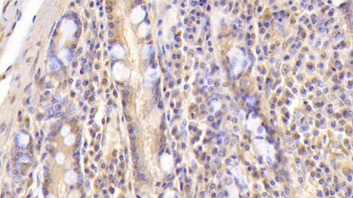 DAB staining on IHC-P; Sample: Human Liver Tissue; Primary Ab: 30ug/ml Mouse Anti-Human APOB Antibody; Second Ab: 2ug/mL HRP-Linked Caprine Anti-Mouse IgG Polyclonal Antibody