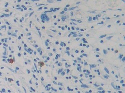 DAB staining on IHC-P; Sample: Human Colorectal cancer Tissue; Primary Ab: 30ug/ml Mouse Anti-Human RETN Antibody; Second Ab: 2ug/mL HRP-Linked Caprine Anti-Mouse IgG Polyclonal Antibody