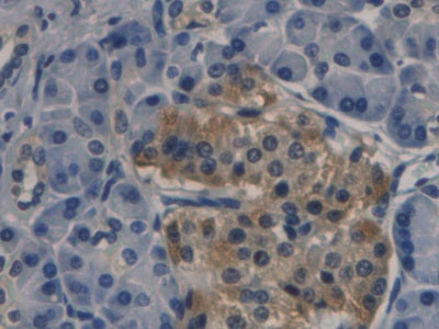 DAB staining on IHC-P; Sample: Human Liver cancer Tissue; Primary Ab: 30ug/ml Mouse Anti-Human PCT Antibody; Second Ab: 2ug/mL HRP-Linked Caprine Anti-Mouse IgG Polyclonal Antibody