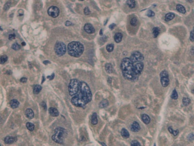 DAB staining on IHC-P; Sample: Human Liver Tissue; Primary Ab: 30ug/ml Mouse Anti-Human PCT Antibody; Second Ab: 2ug/mL HRP-Linked Caprine Anti-Mouse IgG Polyclonal Antibody