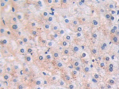 DAB staining on IHC-P; Sample: Human Pancreatic cancer Tissue; Primary Ab: 30ug/ml Mouse Anti-Human BNP Antibody; Second Ab: 2ug/mL HRP-Linked Caprine Anti-Mouse IgG Polyclonal Antibody