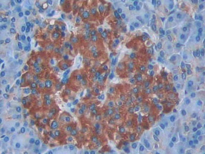 DAB staining on IHC-P; Sample: Human Stomach cancer Tissue; Primary Ab: 40ug/ml Mouse Anti-Human CCK8 Antibody; Second Ab: 2ug/mL HRP-Linked Caprine Anti-Mouse IgG Polyclonal Antibody