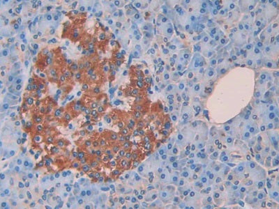 DAB staining on IHC-P; Sample: Human Stomach cancer Tissue; Primary Ab: 40ug/ml Mouse Anti-Human CCK8 Antibody; Second Ab: 2ug/mL HRP-Linked Caprine Anti-Mouse IgG Polyclonal Antibody