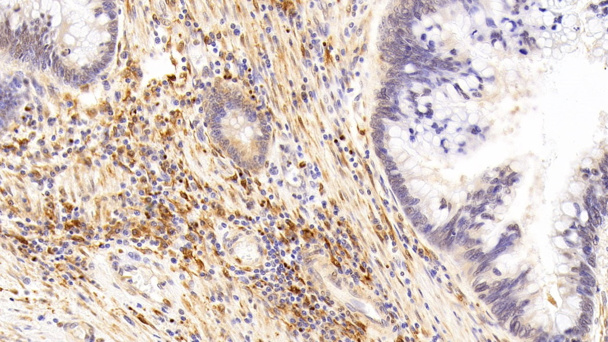 DAB staining on IHC-P; Sample: Human Ovarian cancer Tissue; Primary Ab: 10ug/ml Rabbit Anti-Human P53 Antibody; Second Ab: 2ug/mL HRP-Linked Caprine Anti-Rabbit IgG Polyclonal Antibody
