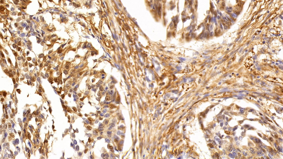 DAB staining on IHC-P; Sample: Human Liver cancer Tissue; Primary Ab: 10ug/ml Rabbit Anti-Human P53 Antibody; Second Ab: 2ug/mL HRP-Linked Caprine Anti-Rabbit IgG Polyclonal Antibody