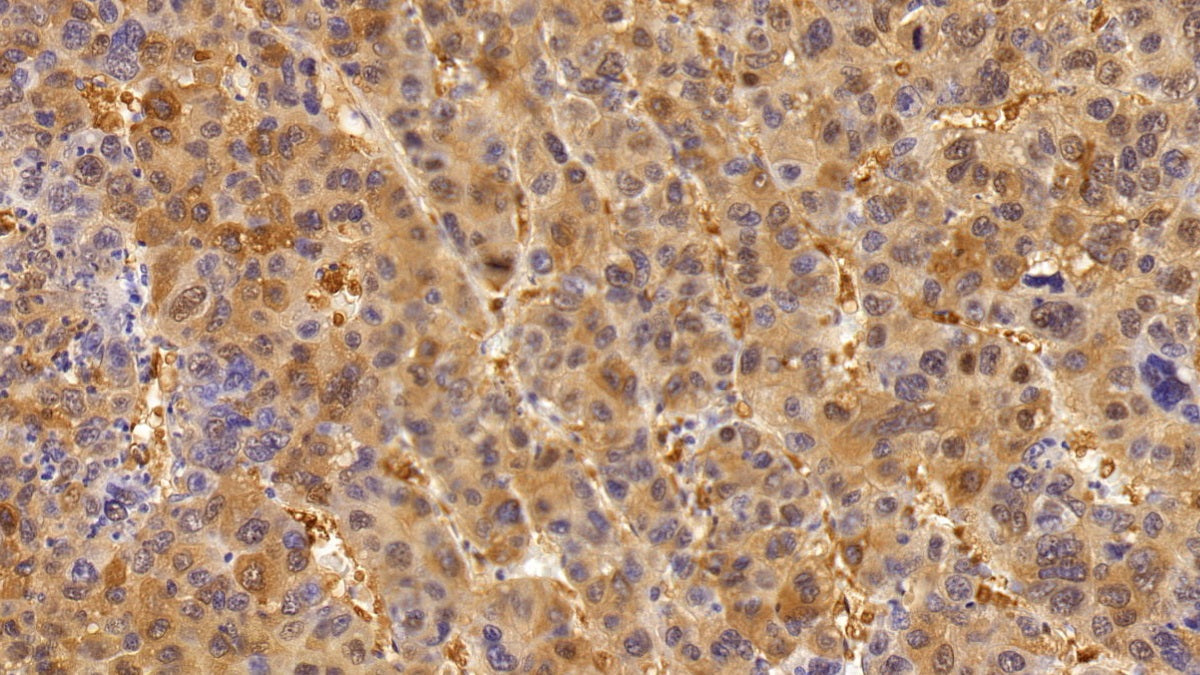 DAB staining on IHC-P; Sample: Human Stomach cancer Tissue; Primary Ab: 10ug/ml Rabbit Anti-Human P53 Antibody; Second Ab: 2ug/mL HRP-Linked Caprine Anti-Rabbit IgG Polyclonal Antibody