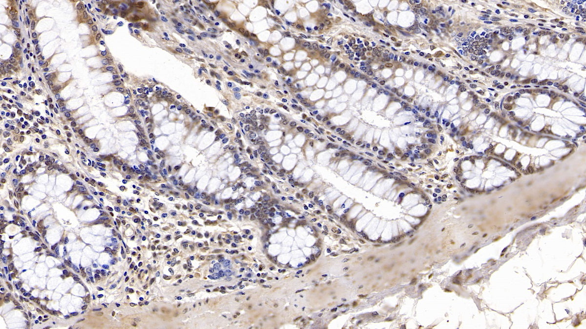 DAB staining on IHC-P; Samples: Human Liver Tissue; Primary Ab: 10ug/ml Mouse Anti-Human IGFBP4 Antibody; Second Ab: 2ug/mL HRP-Linked Caprine Anti-Mouse IgG Polyclonal Antibody