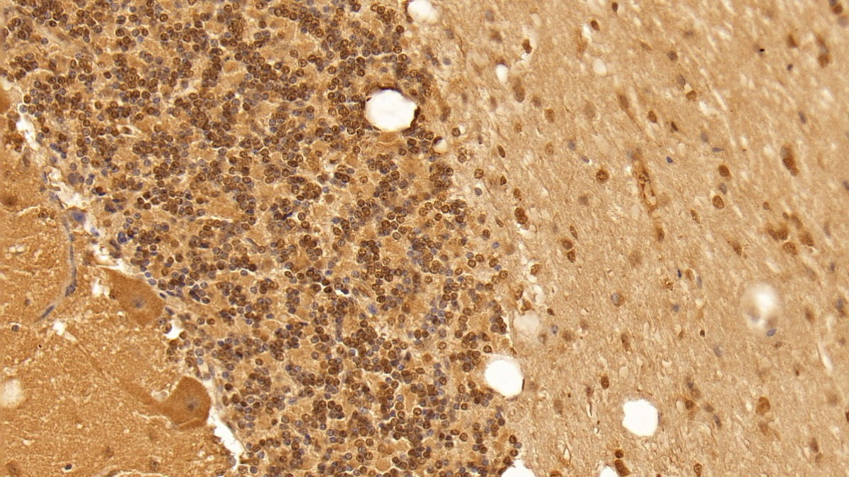 DAB staining on IHC-P; Sample: Human Colon Tissue; Primary Ab: 20ug/ml Mouse Anti-Human TGFb1 Antibody; Second Ab: 2ug/mL HRP-Linked Caprine Anti-Mouse IgG Polyclonal Antibody