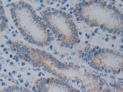 DAB staining on IHC-P; Sample: Human Breast cancer Tissue; Primary Ab: 30ug/ml Mouse Anti-Rat AGR2 Antibody; Second Ab: 2ug/mL HRP-Linked Caprine Anti-Mouse IgG Polyclonal Antibody