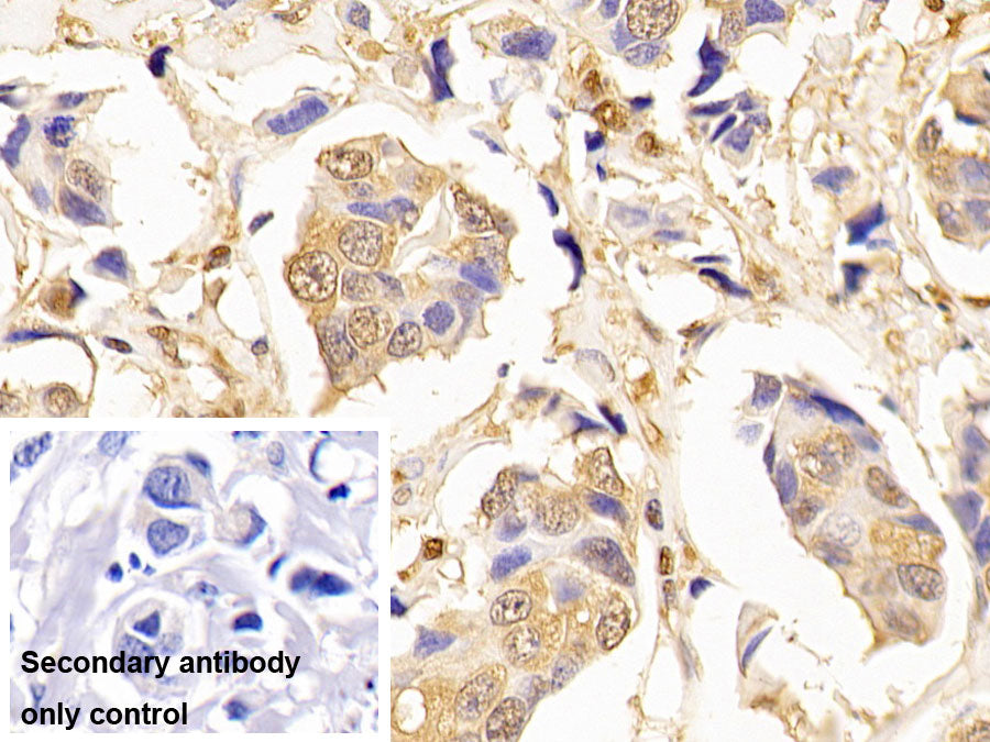 DAB staining on IHC-P; Sample: Human Lung cancer Tissue; Primary Ab: 10ug/ml Mouse Anti-Human GAPDH Antibody; Control: Used PBS instead of primary antibody; Second Ab: 2ug/ml HRP-Linked Caprine Anti-Mouse IgG Polyclonal Antibody